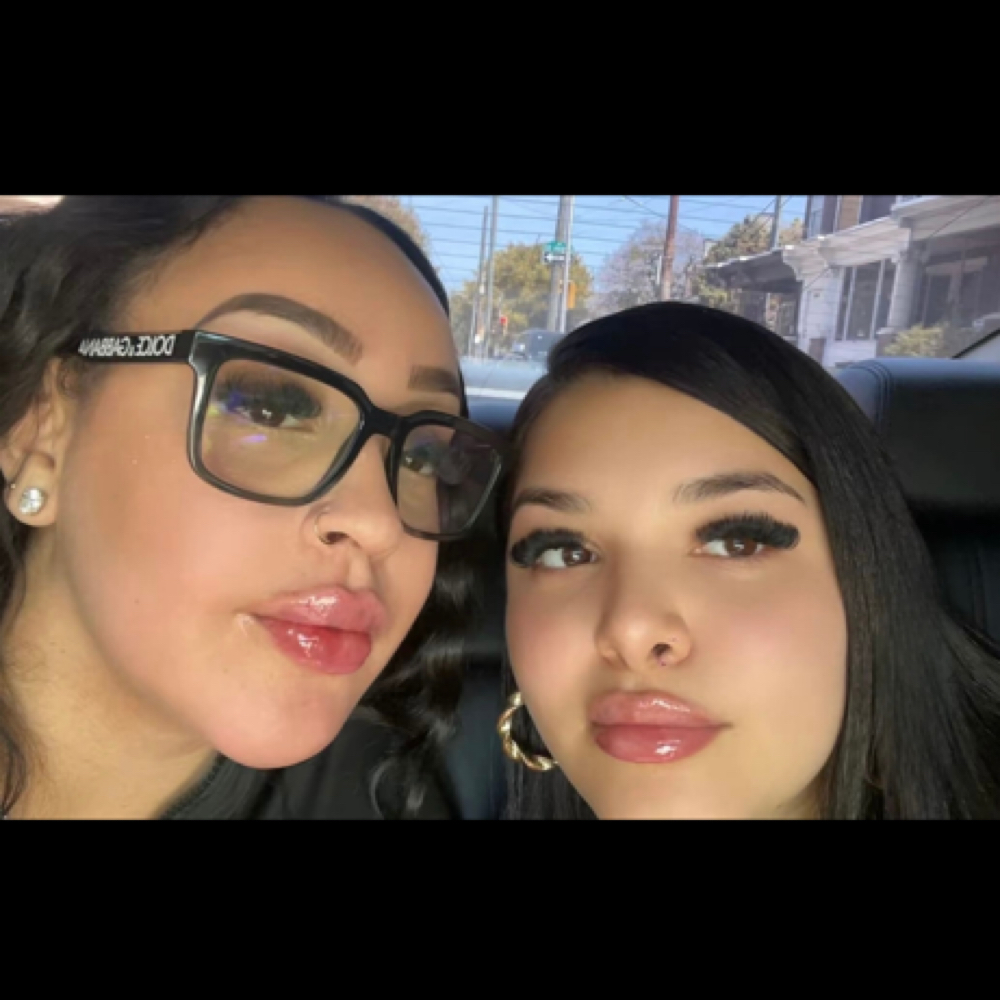 Bestie Deal - (Restylane Kiss) at Pretty By Princess in Philadelphia, PA