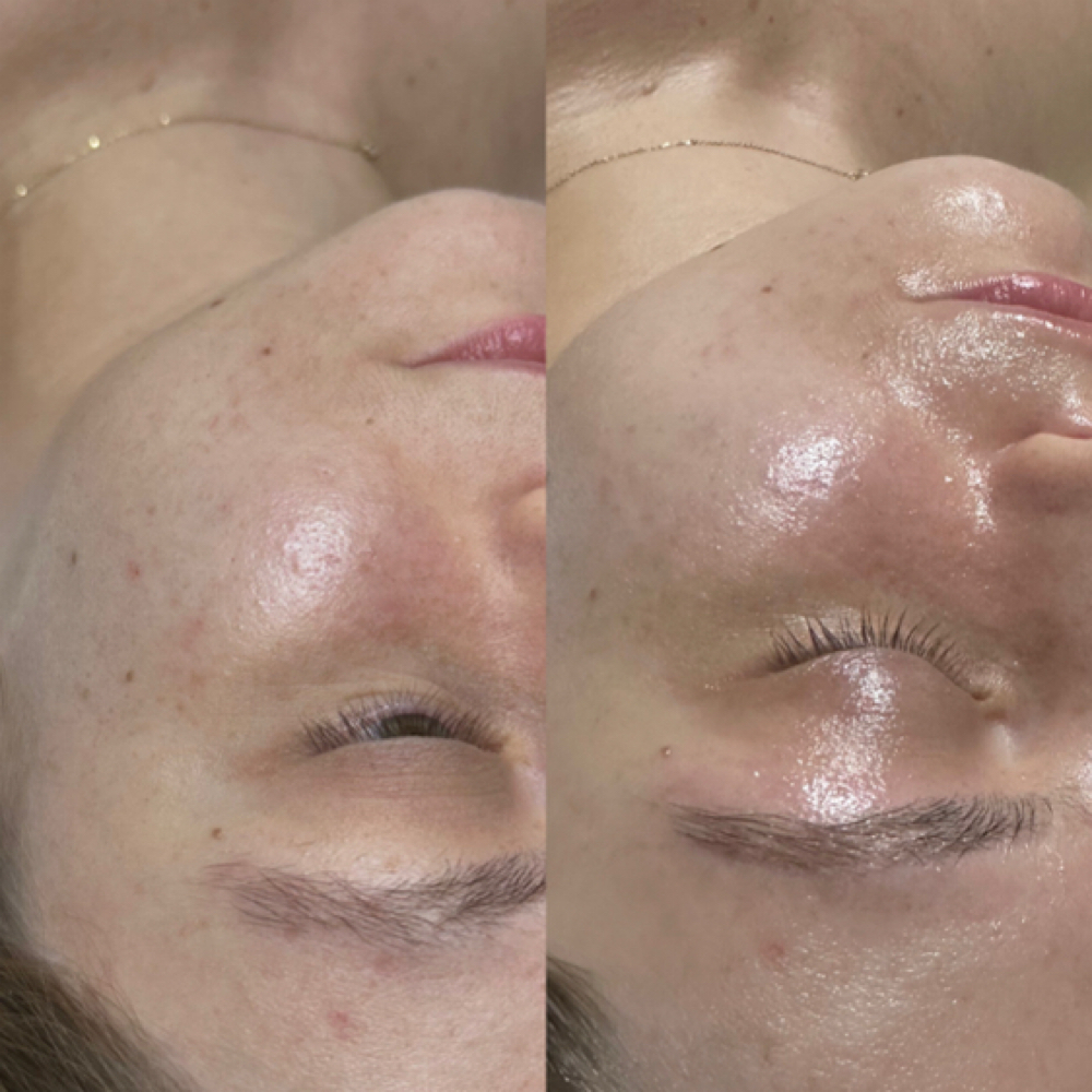 Clear & Calm Acne Facial at The Beauty Bank in Oklahoma City, OK