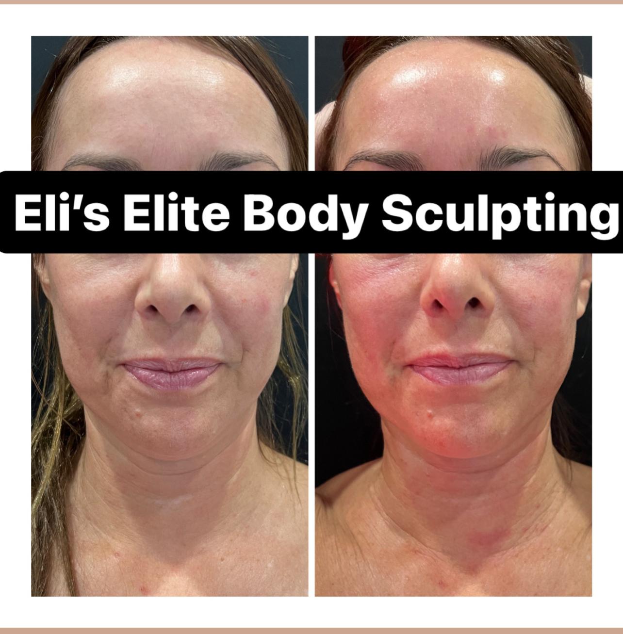 Non- Surgical Face Lift