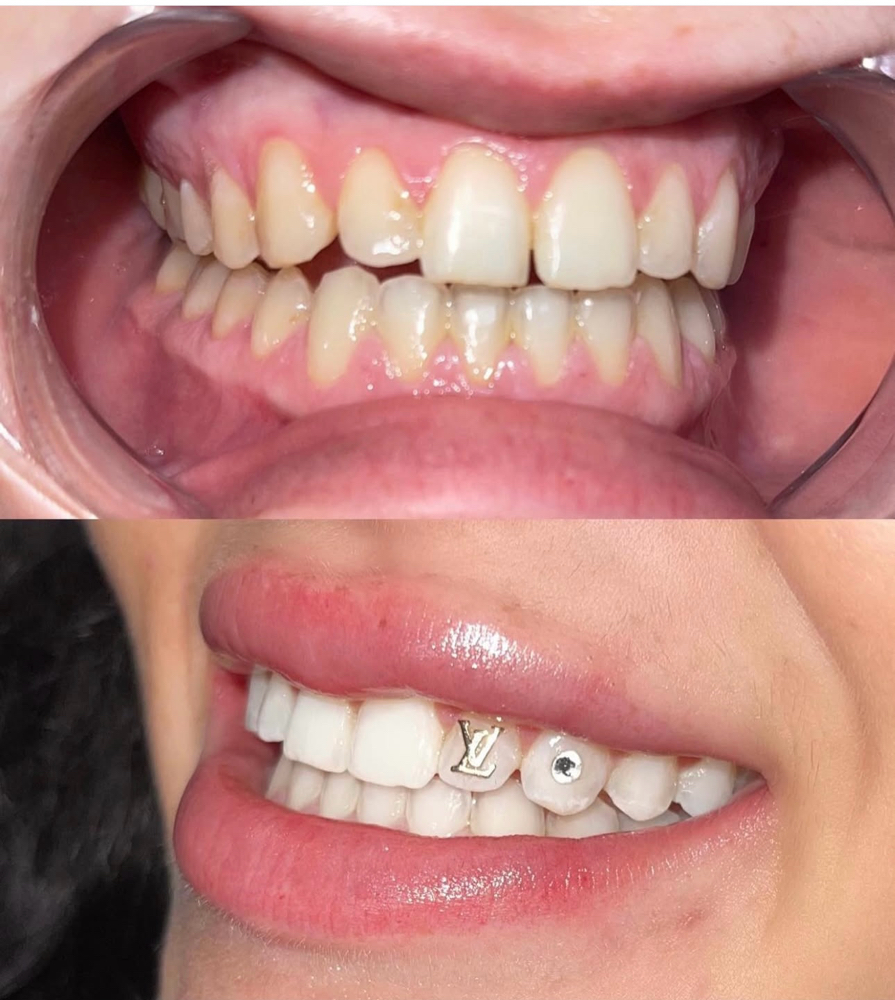 GOLD x CRYSTAL WHITENING™