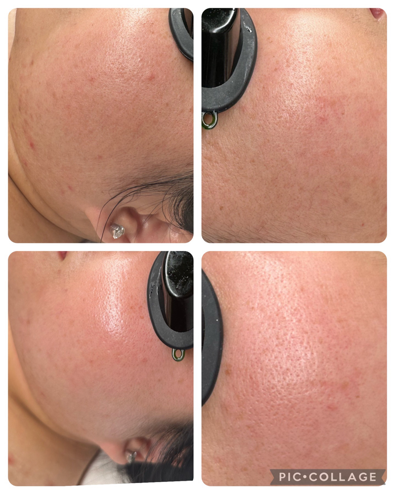 The Fire And Ice Facial