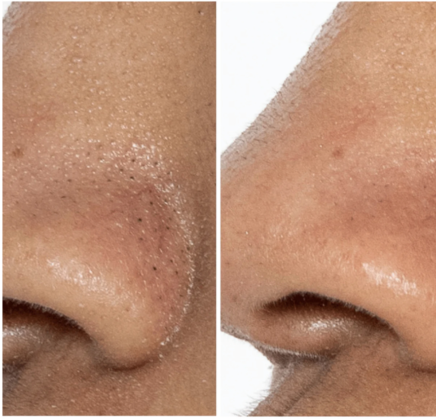 Deep Pore Treatment W/ Extractions