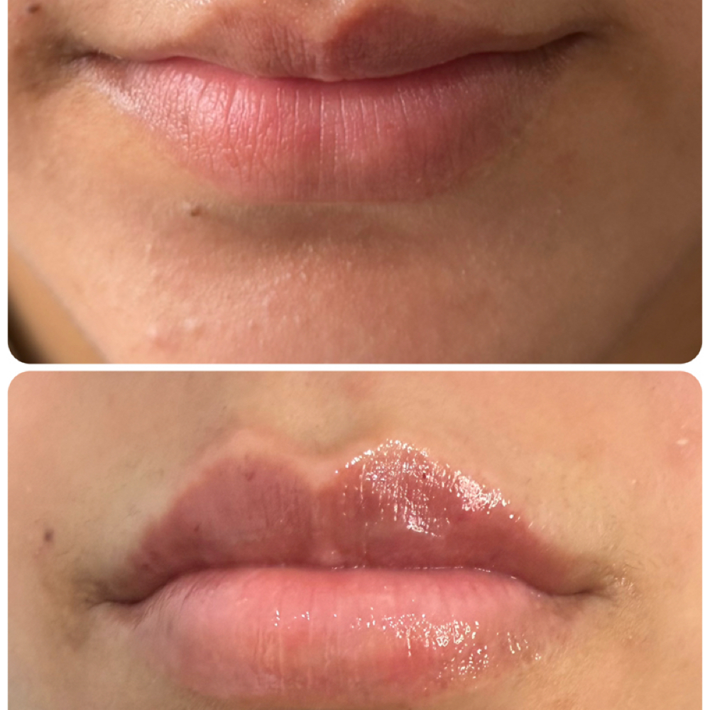The Mily Pout at Mily Aesthetics in Newark, NJ