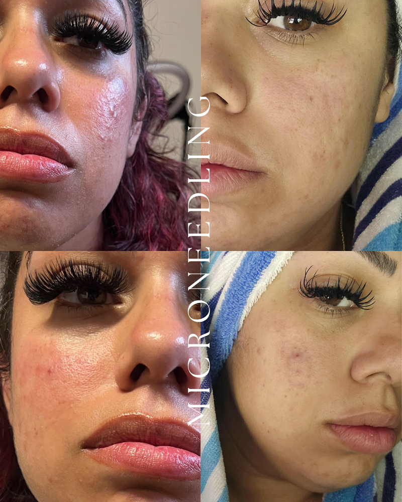 Microneedling at AllyouneedlexBB in Grand Praire, TX