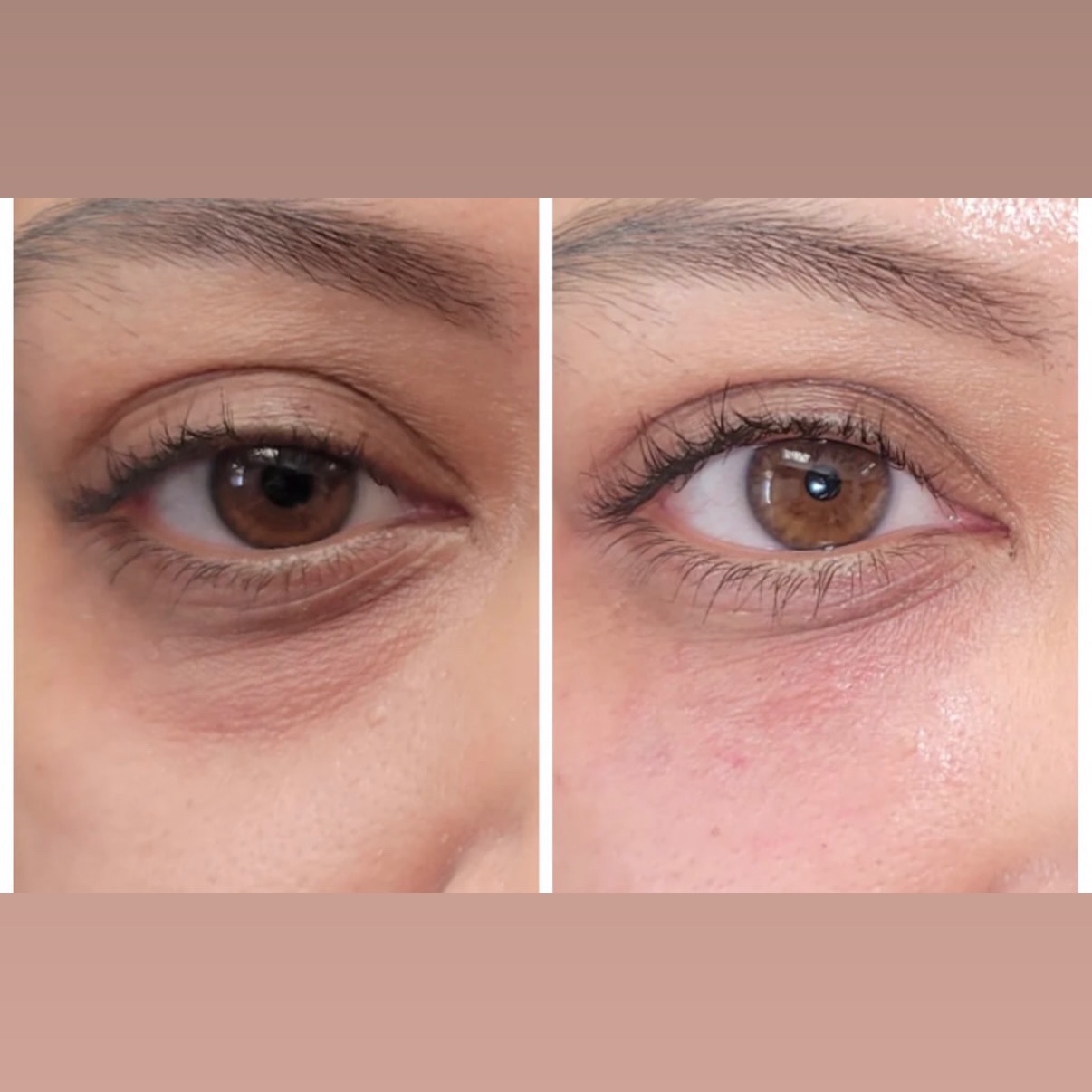 Filler Under Eye at Gold Stone Beauty in mcallen, TX