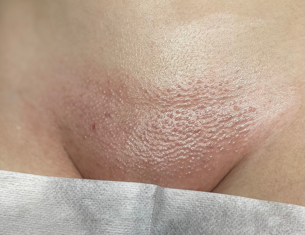 Brazilian Wax