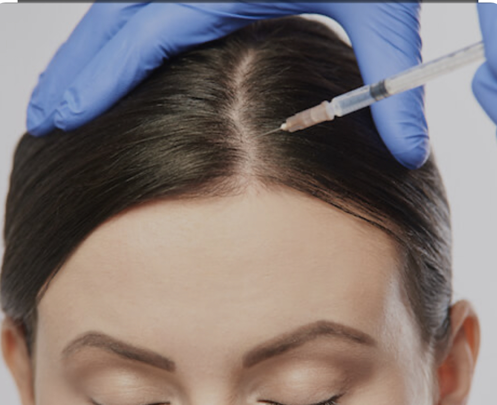 PRP Hair Restoration