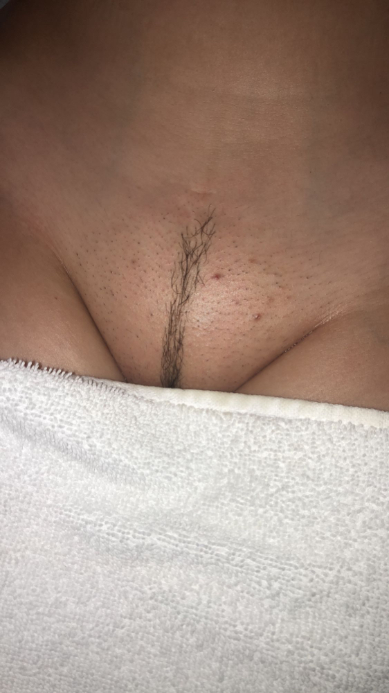Bikini Frech Strip at August Allure Aesthetics LLC in Lehigh Acres, FL