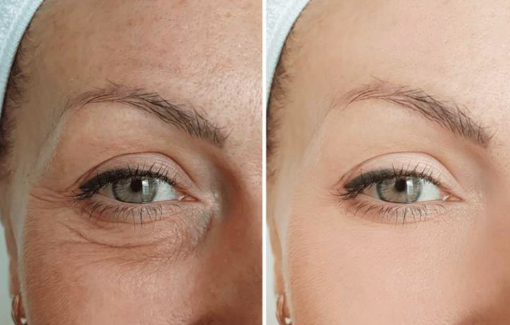 Microneedling at Le Rose beauty Ave in Bronx, NY