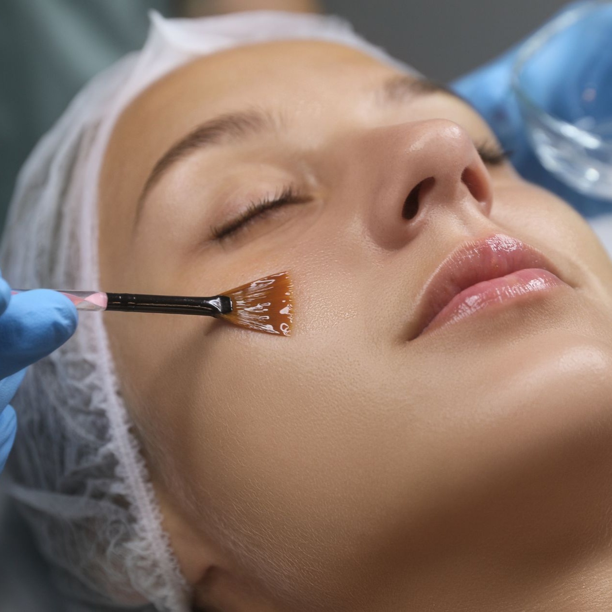 Switch Treatment at HappySkin By Sarah B in Punta Gorda, FL