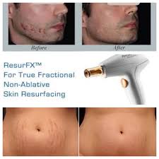 Skin Resurfacing/ResurFX / Scars