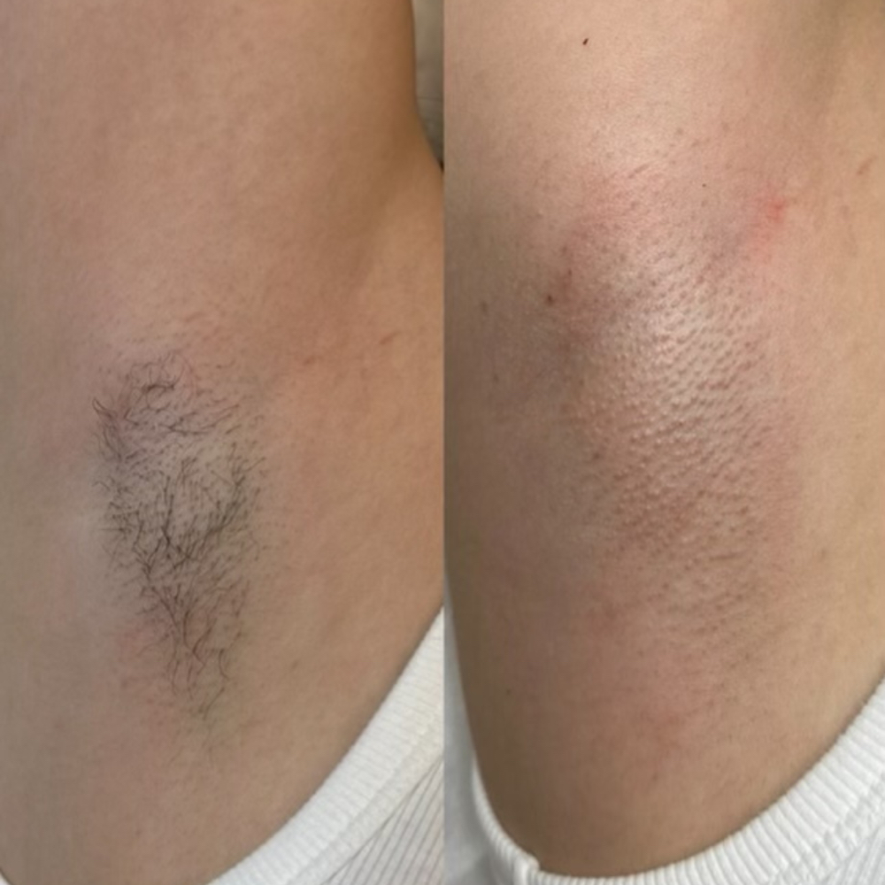 Underarm Wax at Rubi  Esthetica in Phoenix, AZ