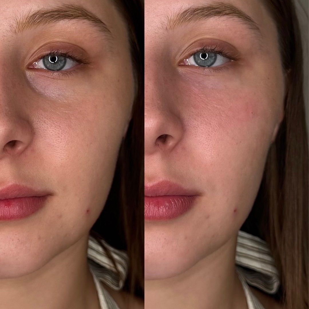 Under-eye filler at Remake Beauty Studio Mission in Mission, TX