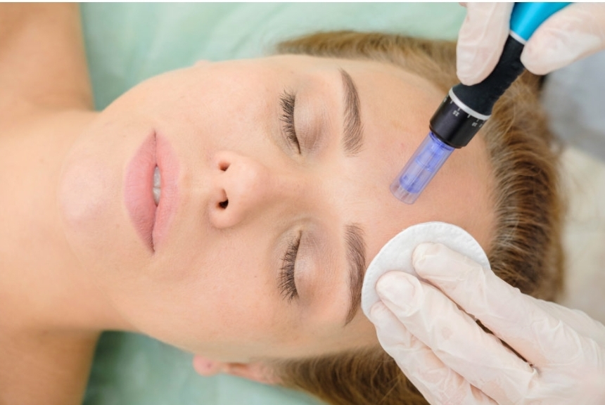 Microneedling (Face, Neck & Chest)