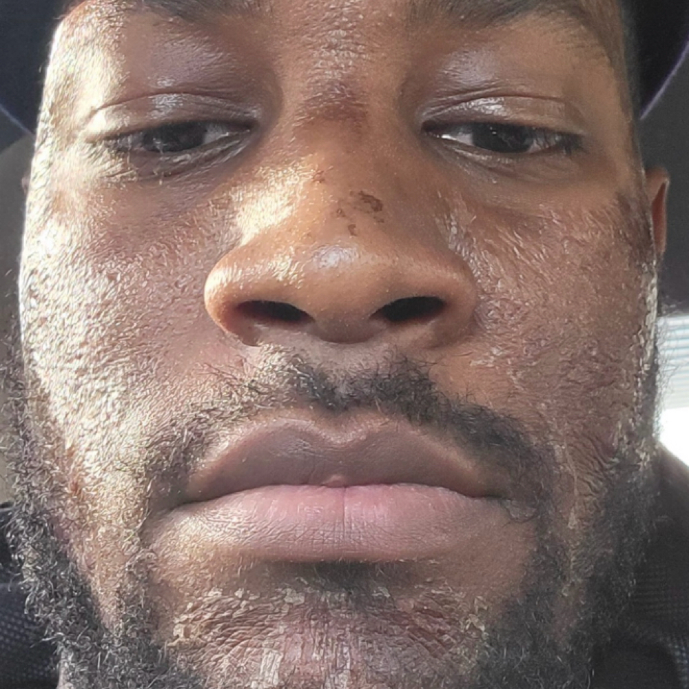 Men Chemical Peel (Full Peel) at Beauty Therapy by Chanel in Tucker, GA