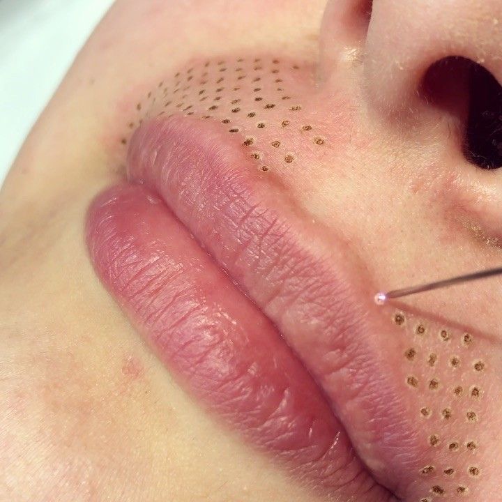Fibroblast Lip Flip