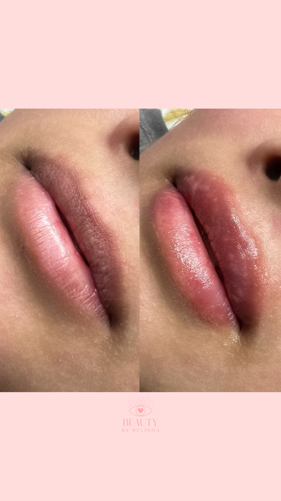 Hyaluronic Lip Filler