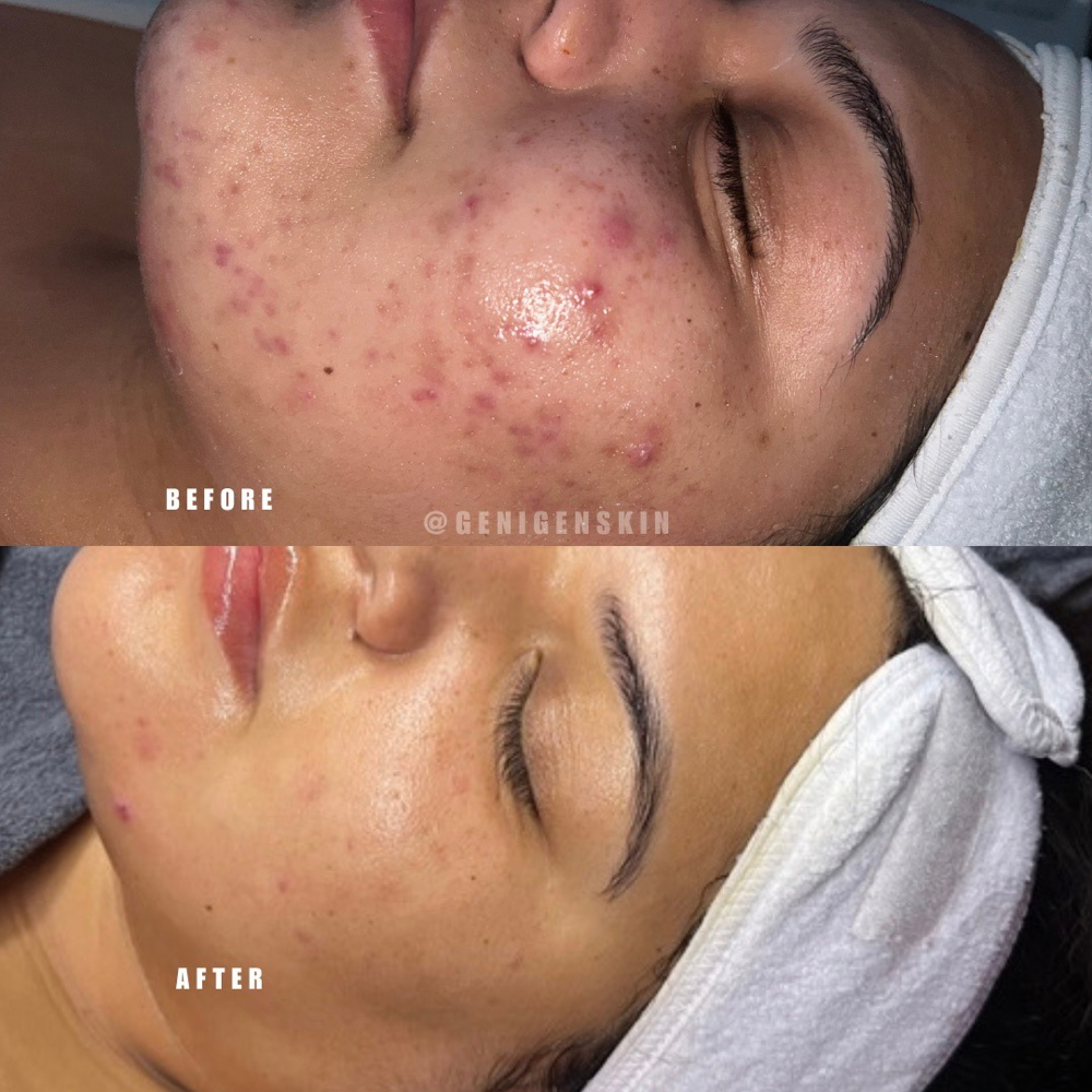 Acne Bootcamp -Follow Up Session