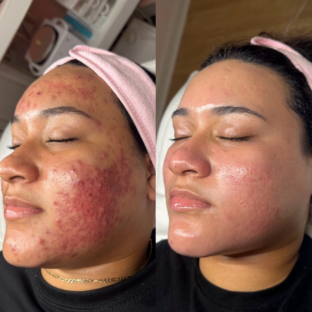 Acne Bootcamp Treatment at Amber The Skin Fairy in Sevierville, TN