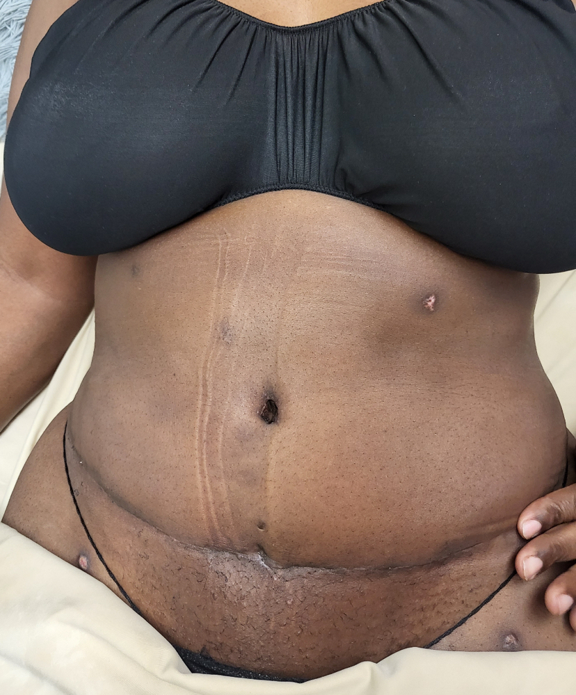 Fibrosis Buildup PostOp Massage