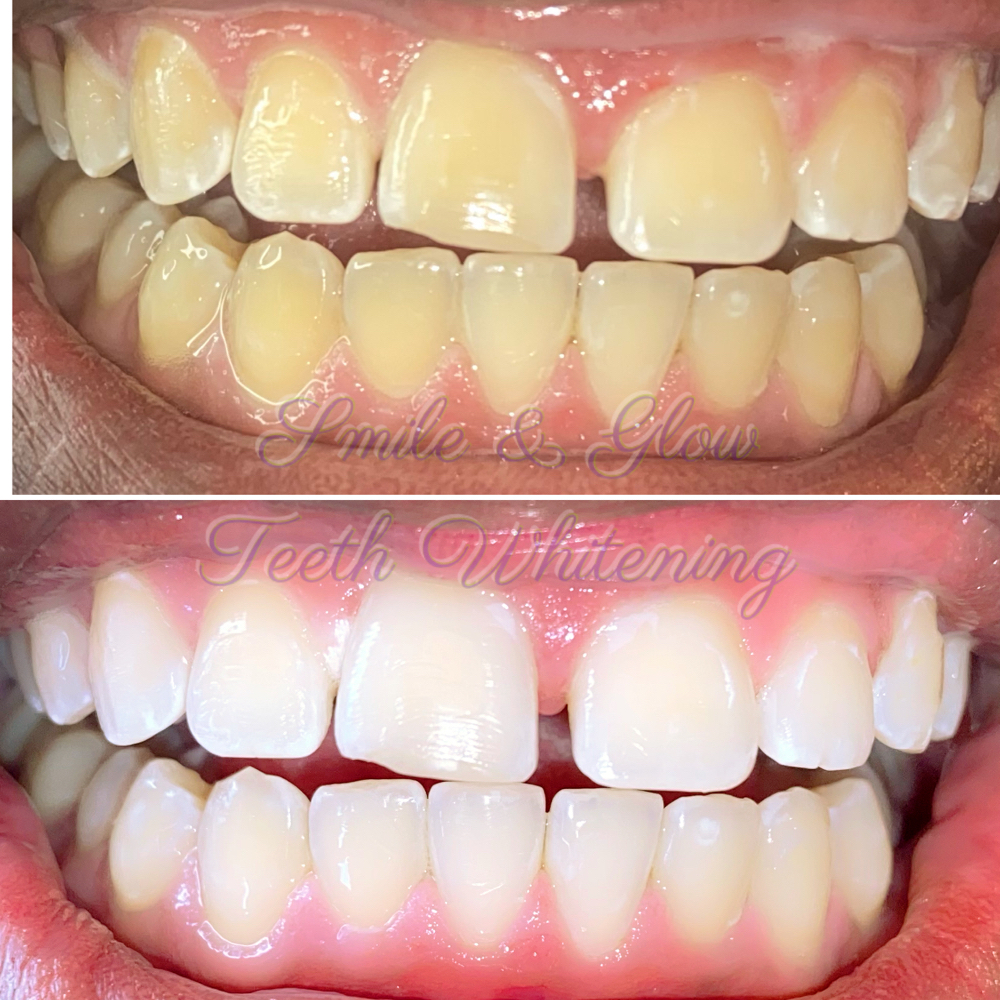 Teeth Whitening (standard)