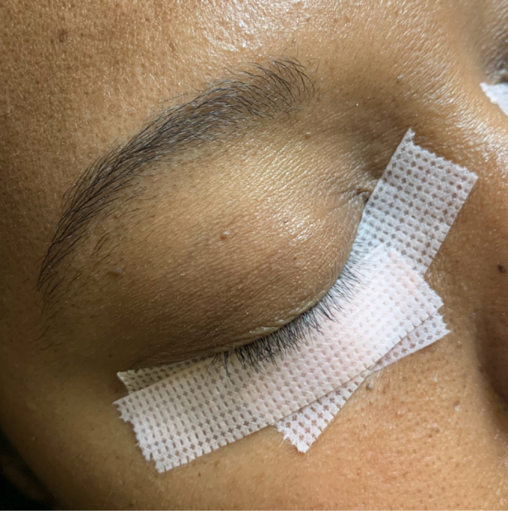 Cluster Removal at Culture Aesthetics in Orange City, FL