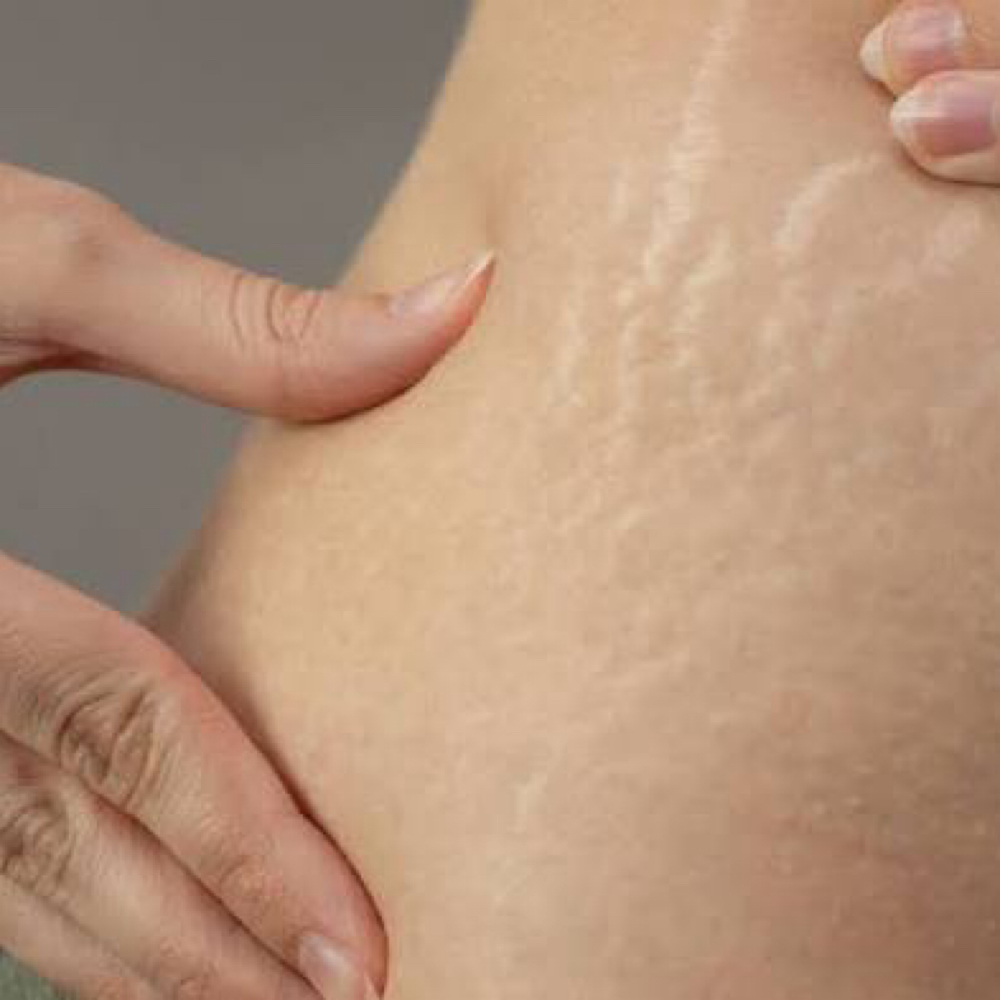 Stretch Marks Session at Sculpting Beauty by Pam LLC in Atascocita, TX