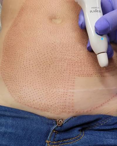 Fibroblast Belly at Leidy Cornelio Spa in Aurora, CO