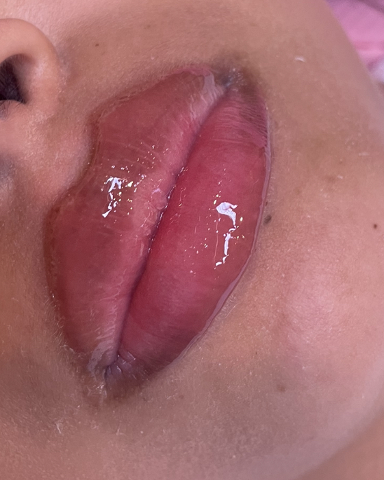 2ml Hyaluronic Lip filler