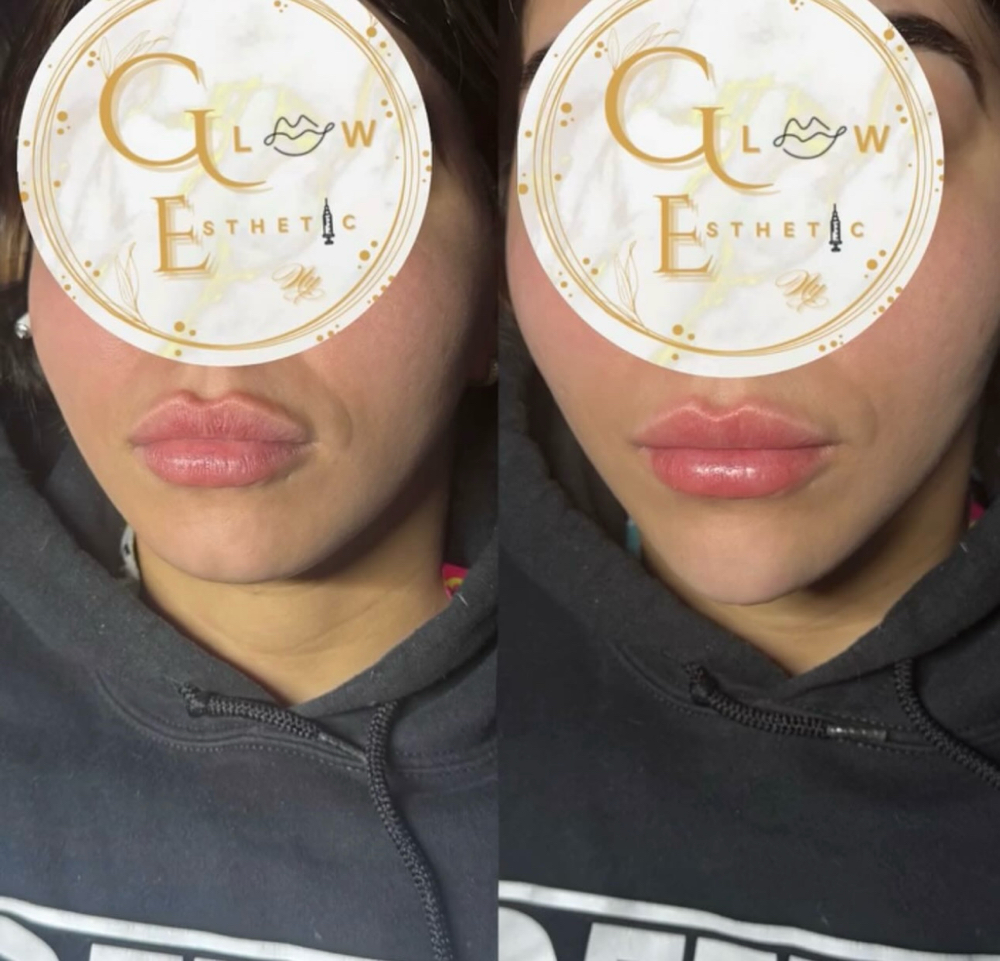 Marcacion de Menton | Chin Filler