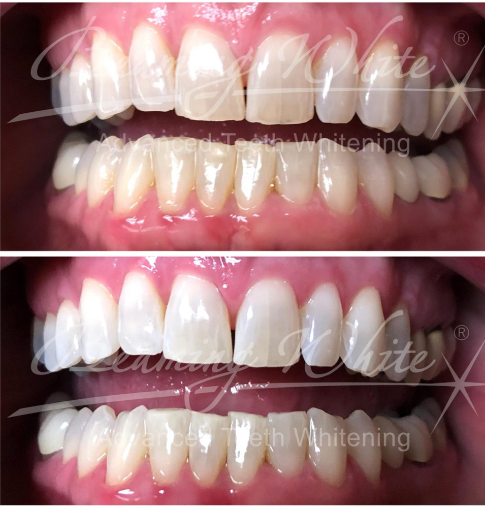 Beaming White Teeth Whitening