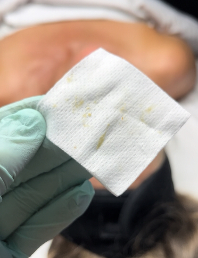Extractions