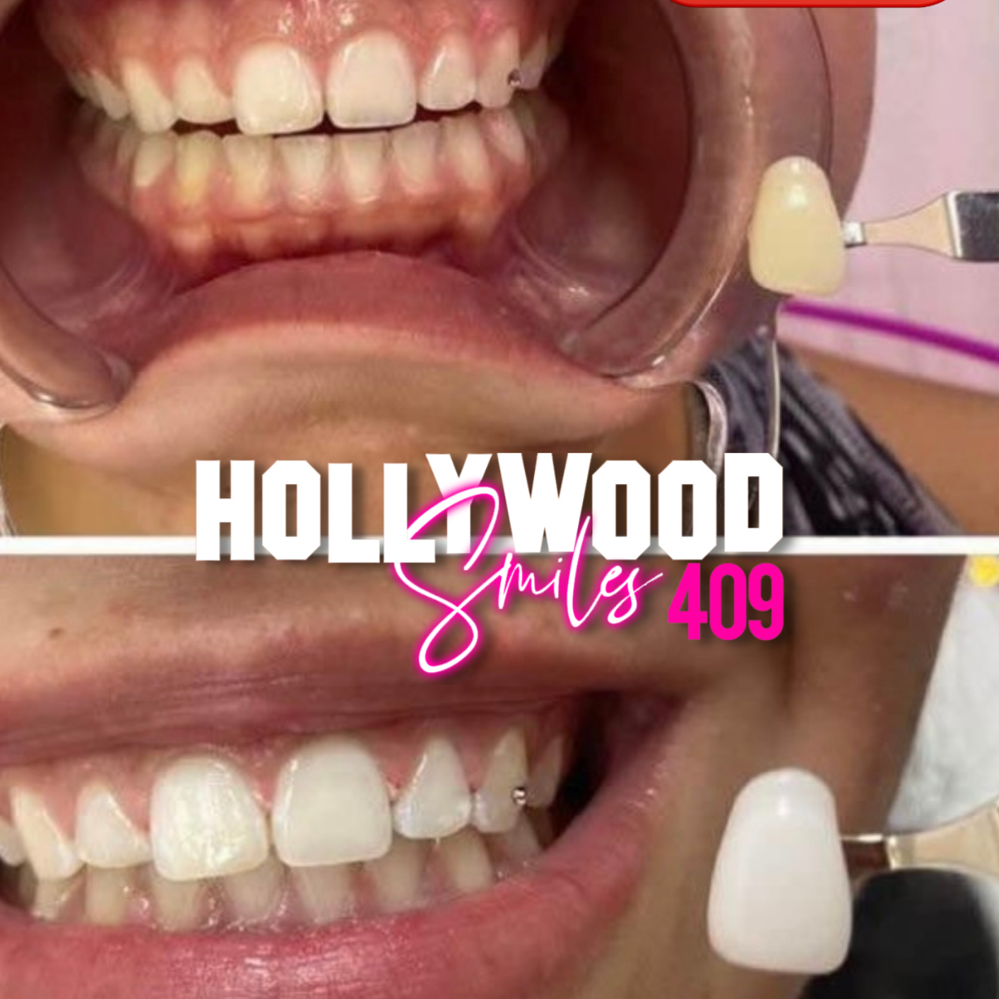 60 min Legendary Teeth Whitening at Hollywood Smiles409 Cosmetic Teeth Whitening in Beaumont, TX