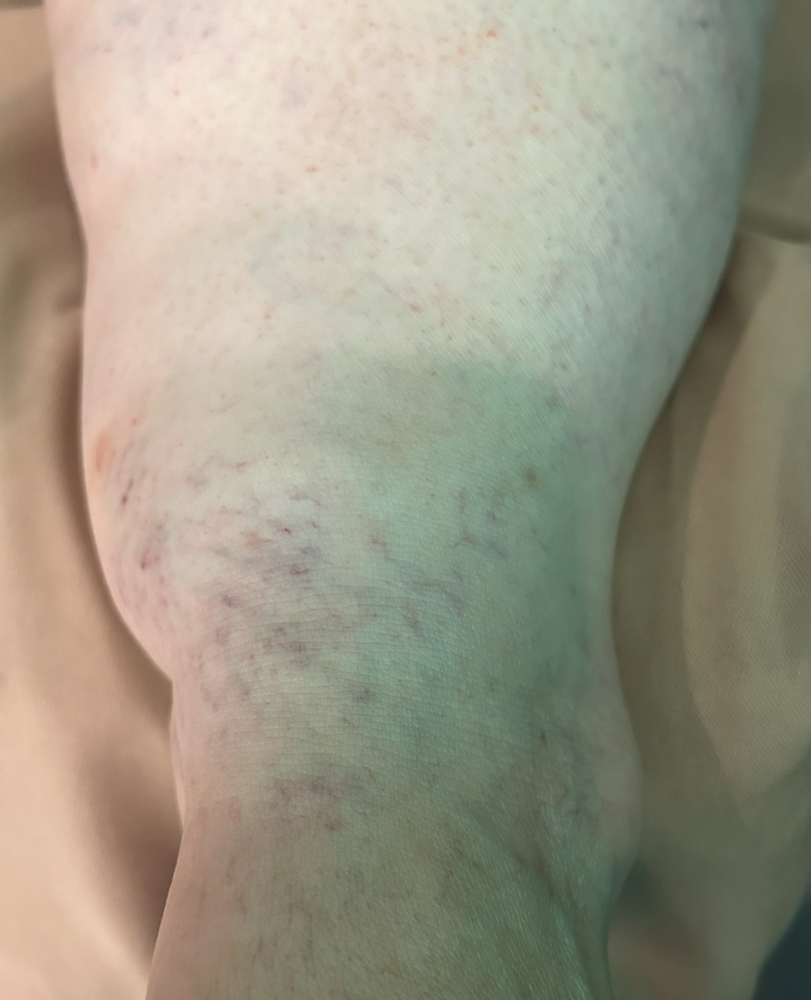 Lymphoma Manual Lymphatic Drainage