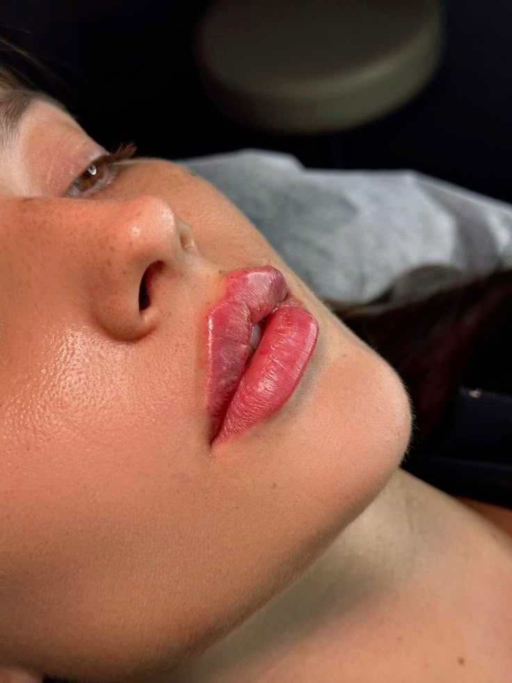 1.5ml Needle-less Hyaluronic Acid
