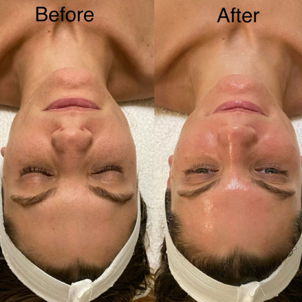 enzyme treatment💚