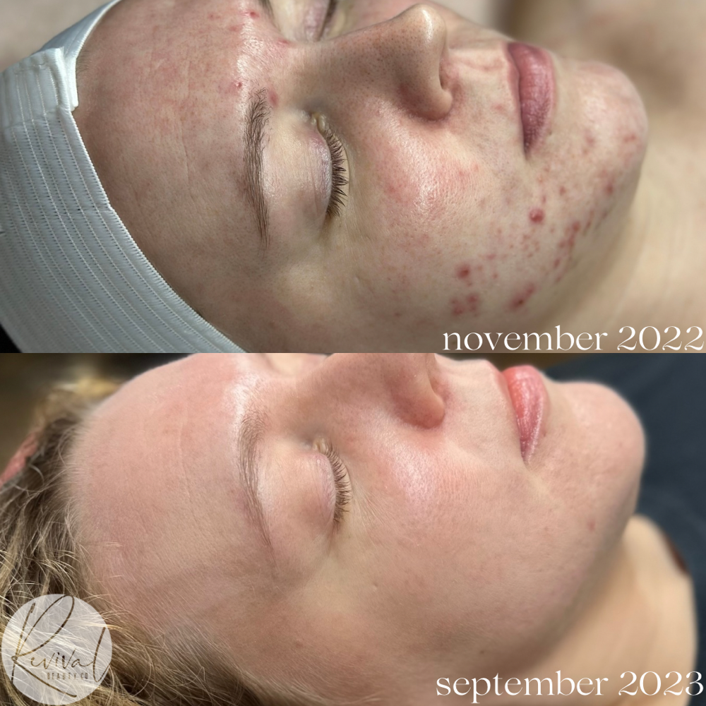 Acne Program - Consultation