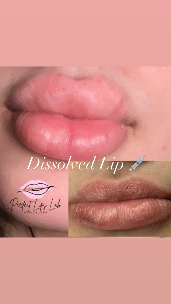 Lip Filler Dissolving