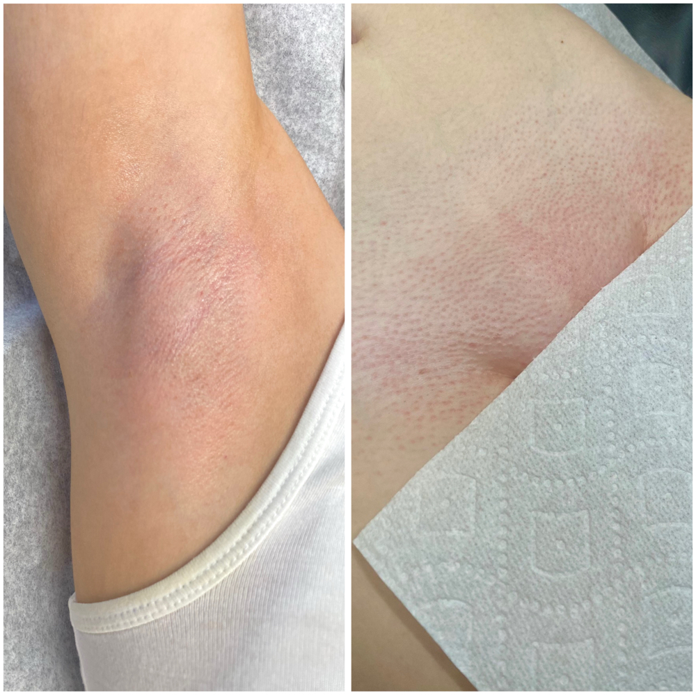 Maintenance Brazilian & Underarms