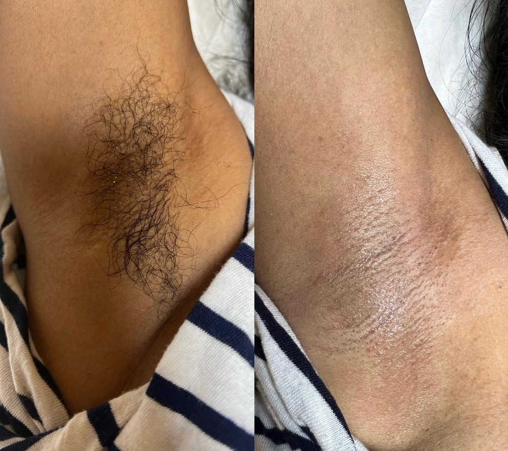 Underarm Wax