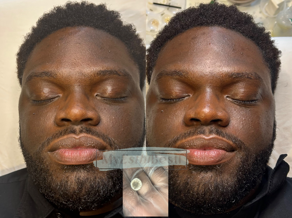 Microdermabrasion Facial
