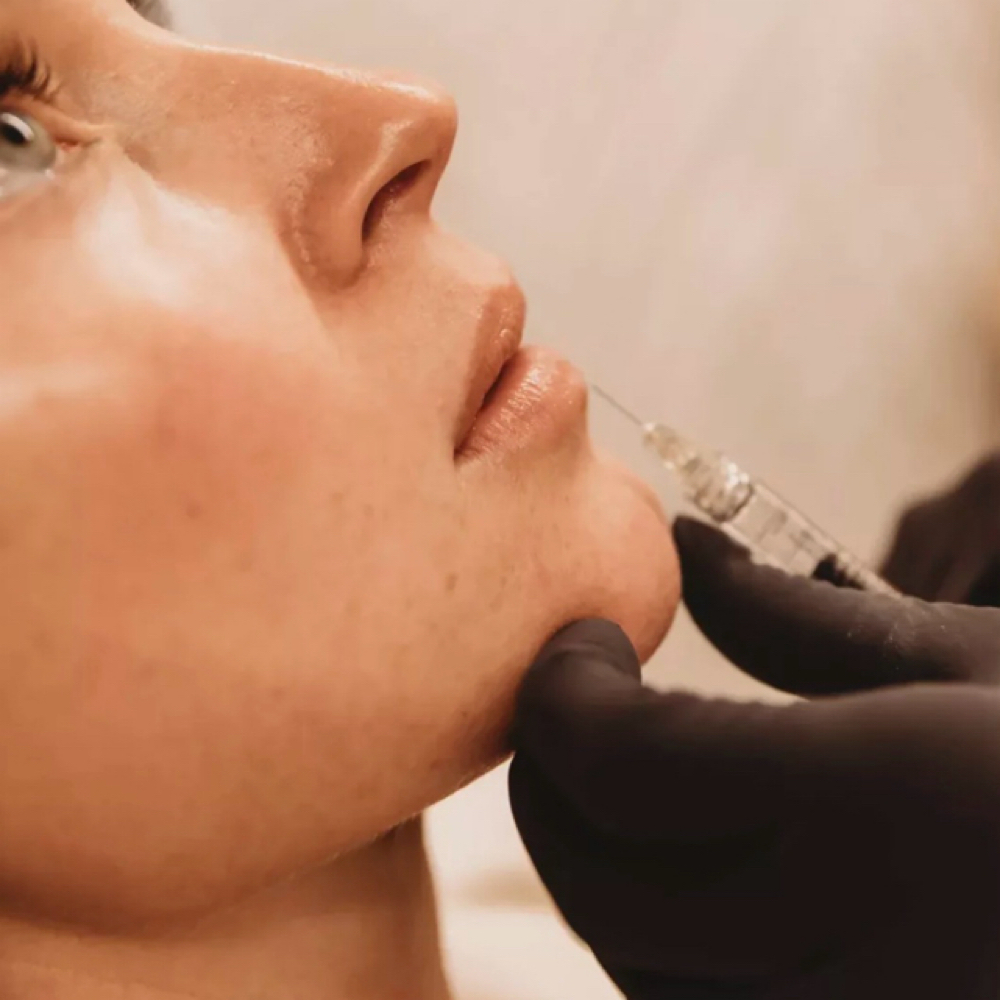 Dermal Filler at BSkinAesthetics in McKinney, TX