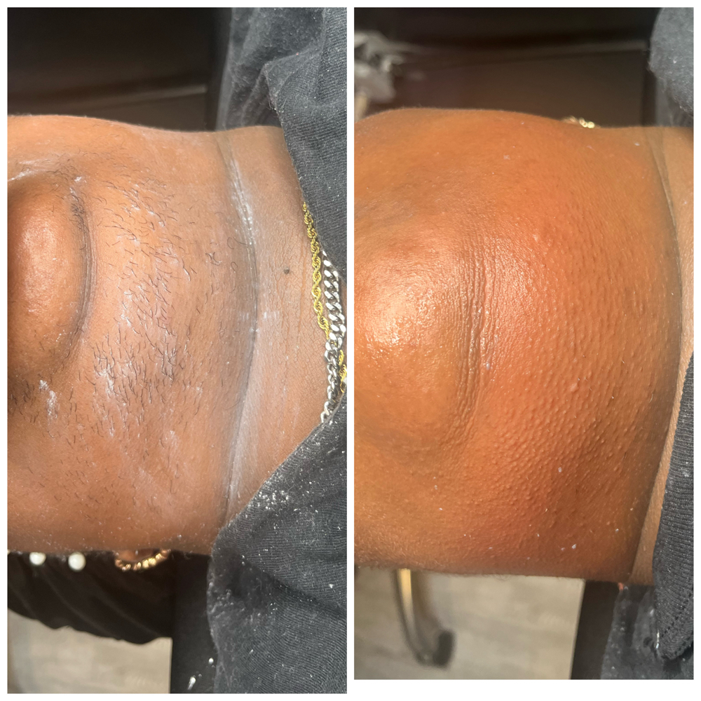 (PCOS) Facial Waxing