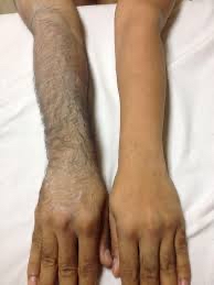 Full Arm Waxing