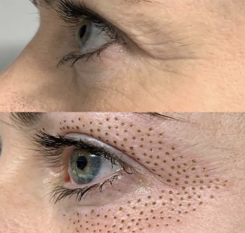 Fibroblast Skin Tightening