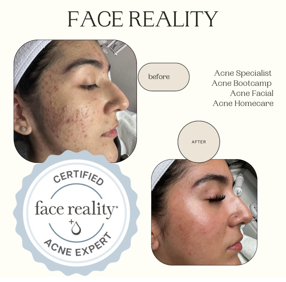 Acne Bootcamp Consultation