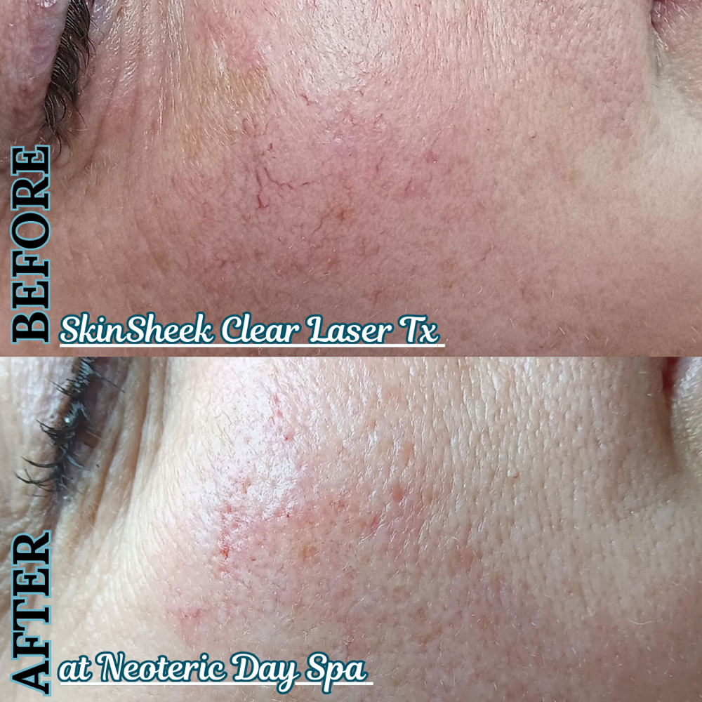 SkinSheek Clear Laser Add-on