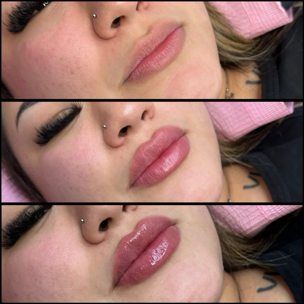 Lip Filler at Beautify Queen in Corpus Christi, TX