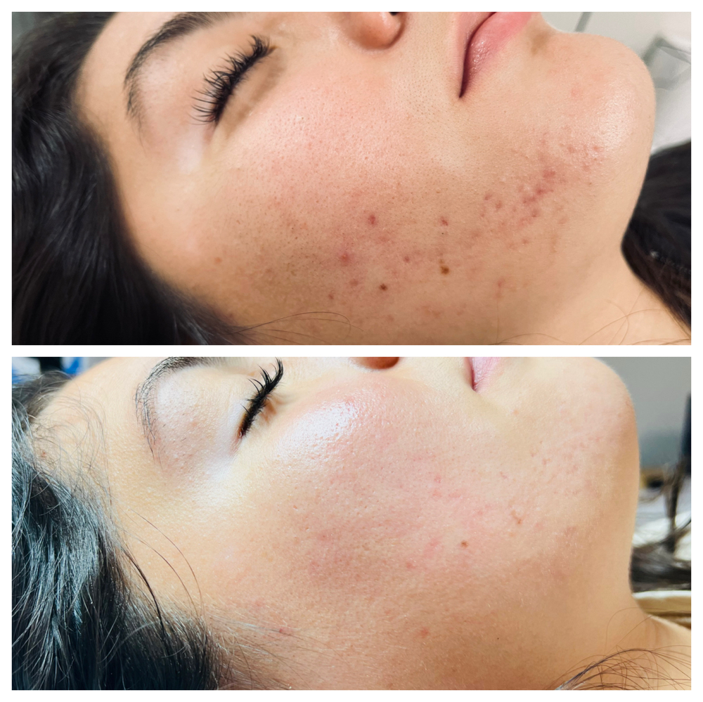 Procell Microchanneling