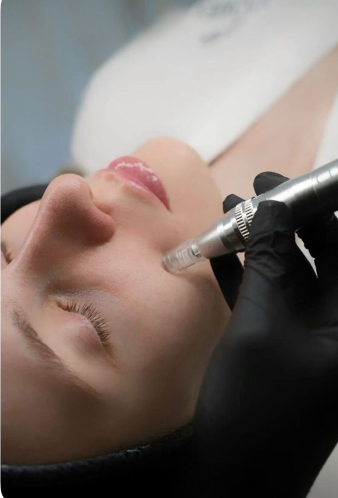 Microneedling